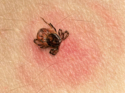 What is post-treatment Lyme disease?