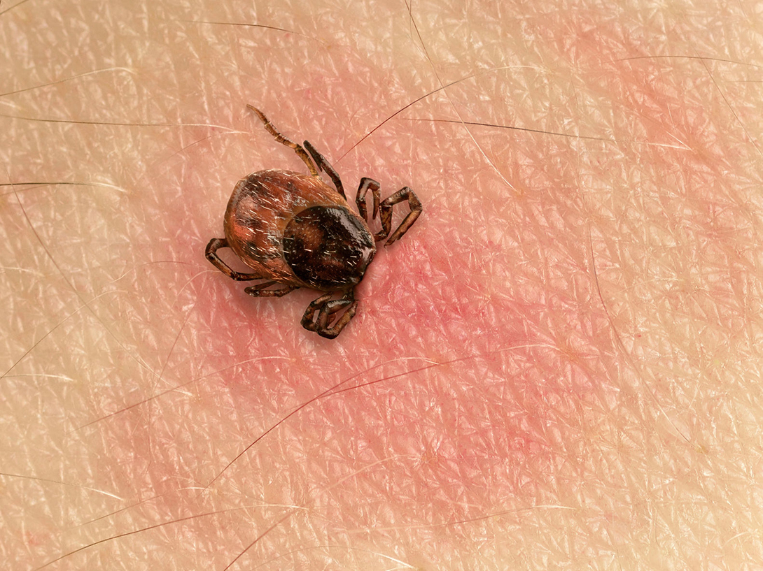 You are currently viewing What is post-treatment Lyme disease?